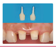 Cùi giả toàn sứ (CAD)